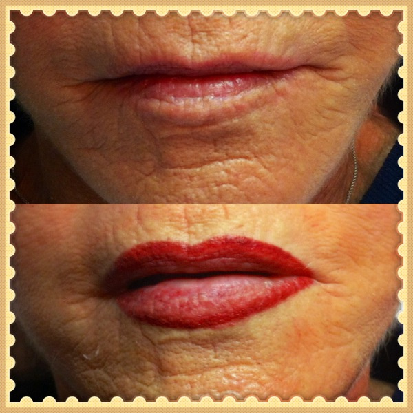 creating fuller lips